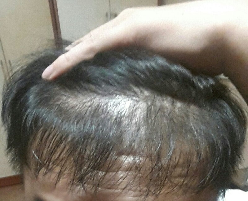 수술후 6개월 형광등.jpg