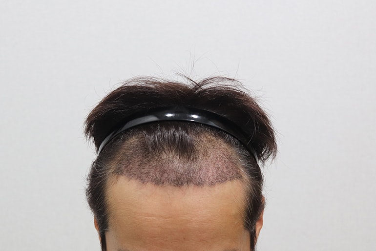 수술2주 경과.jpg