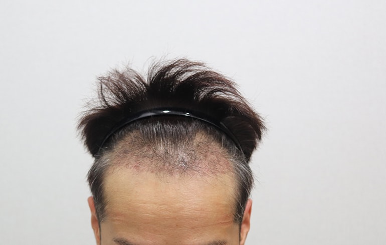1개월 경과.jpg