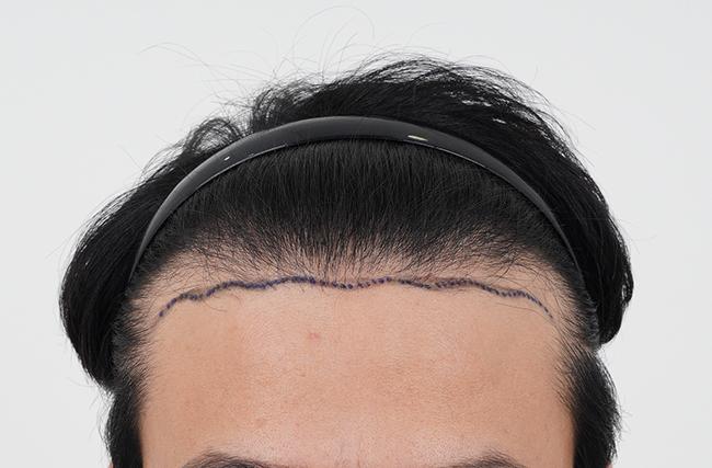 Surgery has been completed with 2500 non-intersected hairs.