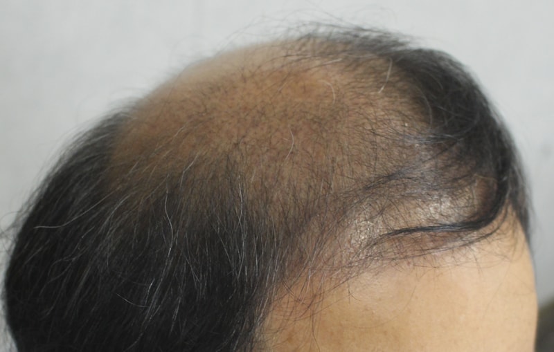 3 months picture of incision 3700 hair transplant