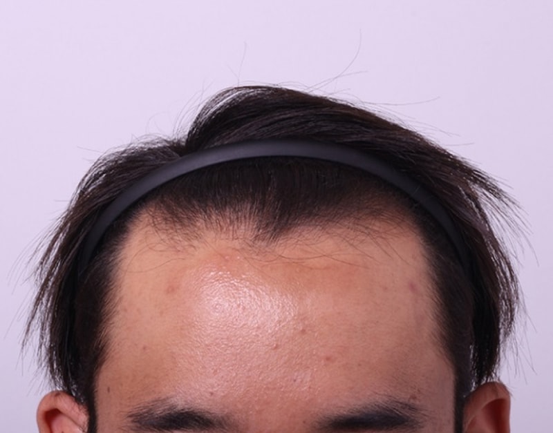 수술전.jpg