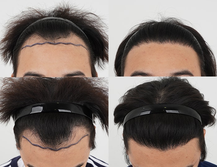 It's been more than a year since I got surgery from Director Moon Hyo-seop of Suwon branch in MOMO HAIR TRANSPLANT.
