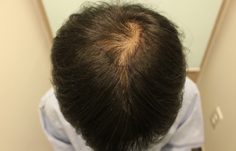 Tearful m-shape, hair loss transplanted with crown hair.. And half a year