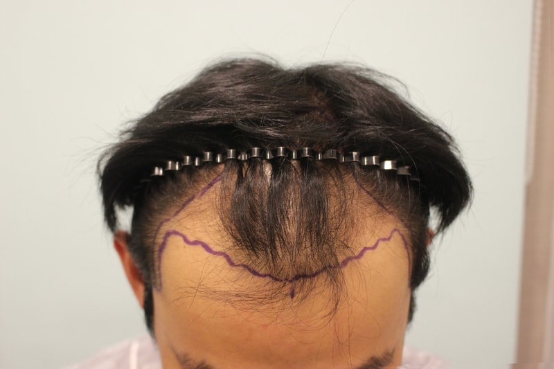 수술하고 1년 변화 정리해봅니다 (심하게 파였던 M자)