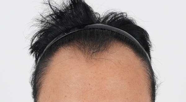 모모성형외과 M자 모발이식 3300모 10개월 결과