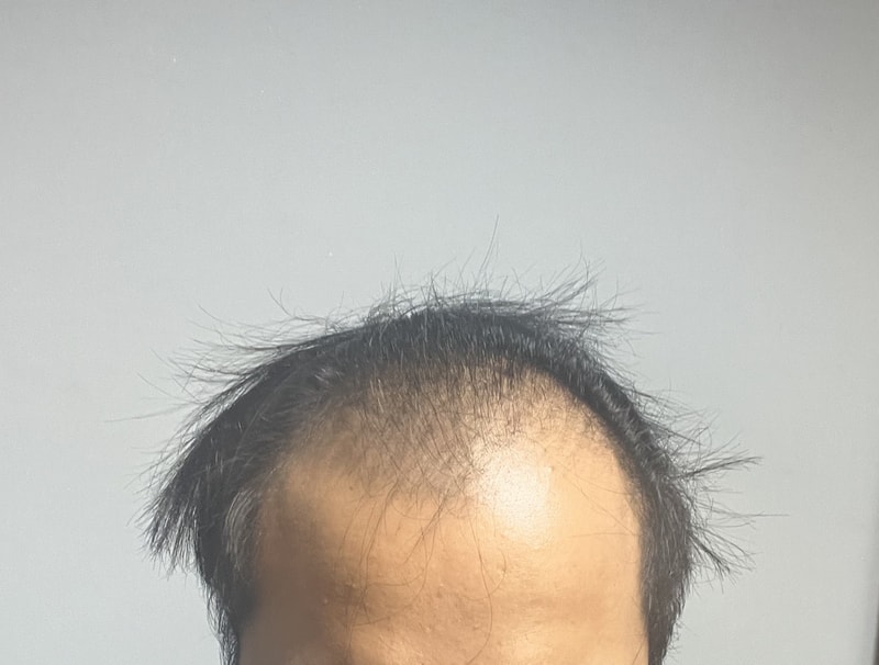 Dana Plastic Surgery Department 6 Months of Hair Loss in 20s