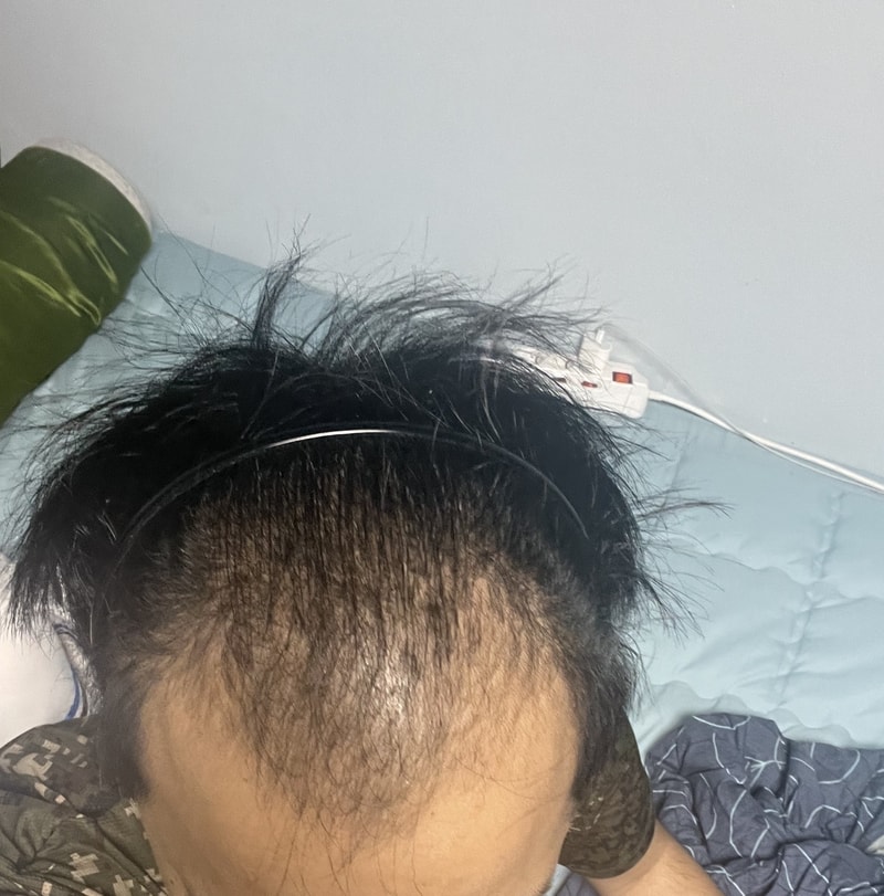 Hair loss is the worst when you're young. I had surgery in Dana