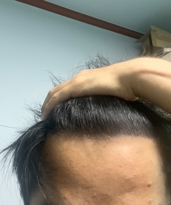 남자_모발이식_자연스럽게.jpg