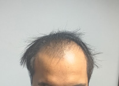 대량모발이식 다나성형외과에서 절개+비절개 혼합 15개월차입니다