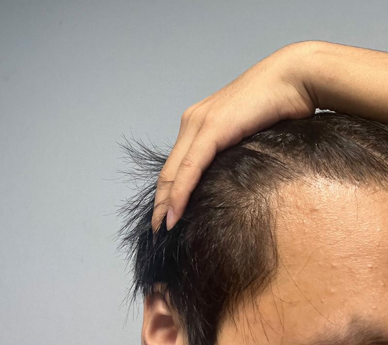 Dana Plastic Surgery Incision Non-Cutting Complex/9 Months