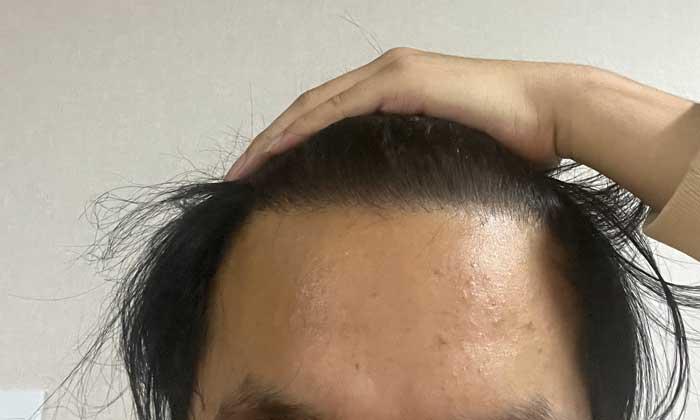 Dana plastic surgery, mass transplant, 10 months