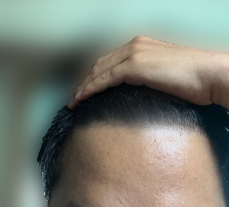 20 years of mass hair transplant.. I'm 13 months old at Dana Plastic Surgery