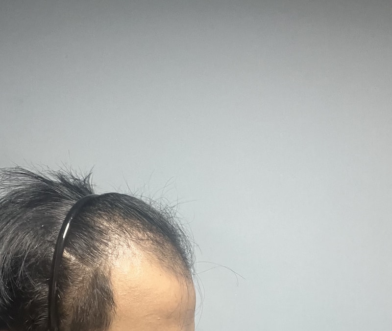 Dana plastic surgery incision/non-excision hair transplant 8 months There's no one in their 20s who's more missing than me