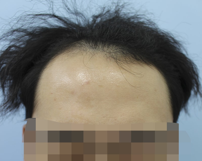 M자 이식하고 난 사진 후기 올립니다!!