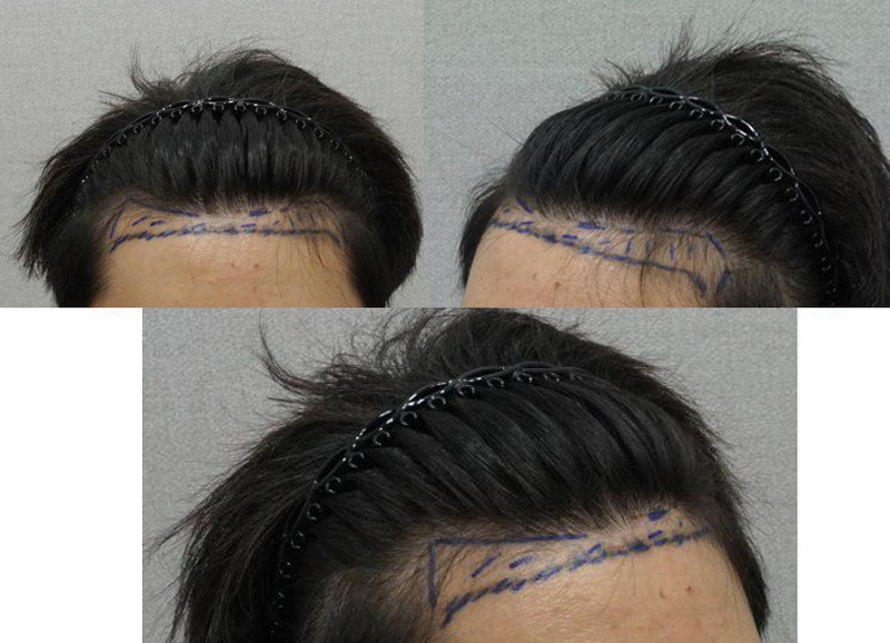 1 year and 5 months of m-shaped hair transplantation