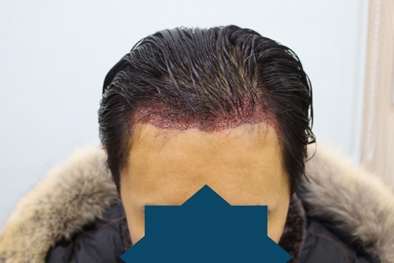 수술후6.jpg