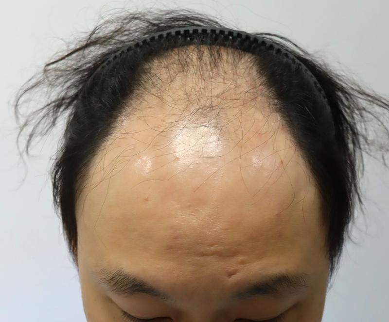新世界的开始，狎鸥亭FORHAIR大量非切开毛发移植2周后半期（闵英基院长）