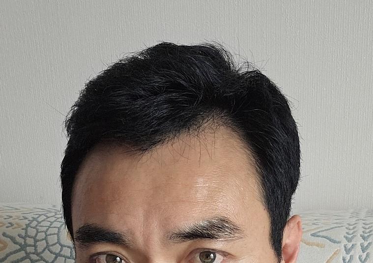 War with sleep on the late day of non-cut hair transplant surgery at Forhair Clinic in Seomyeon, Busan