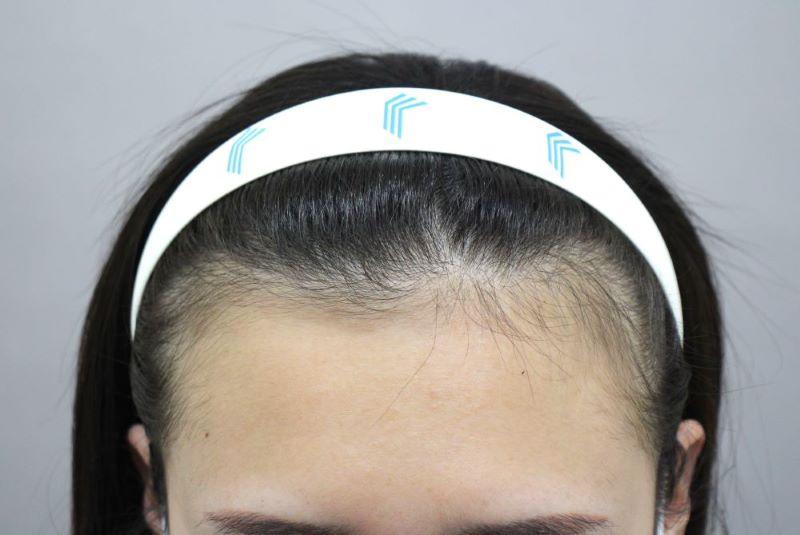 アイユの産毛♥ 大邱ポヘア 女性ヘアライン矯正 非切開毛髪移植 4ヵ月後記