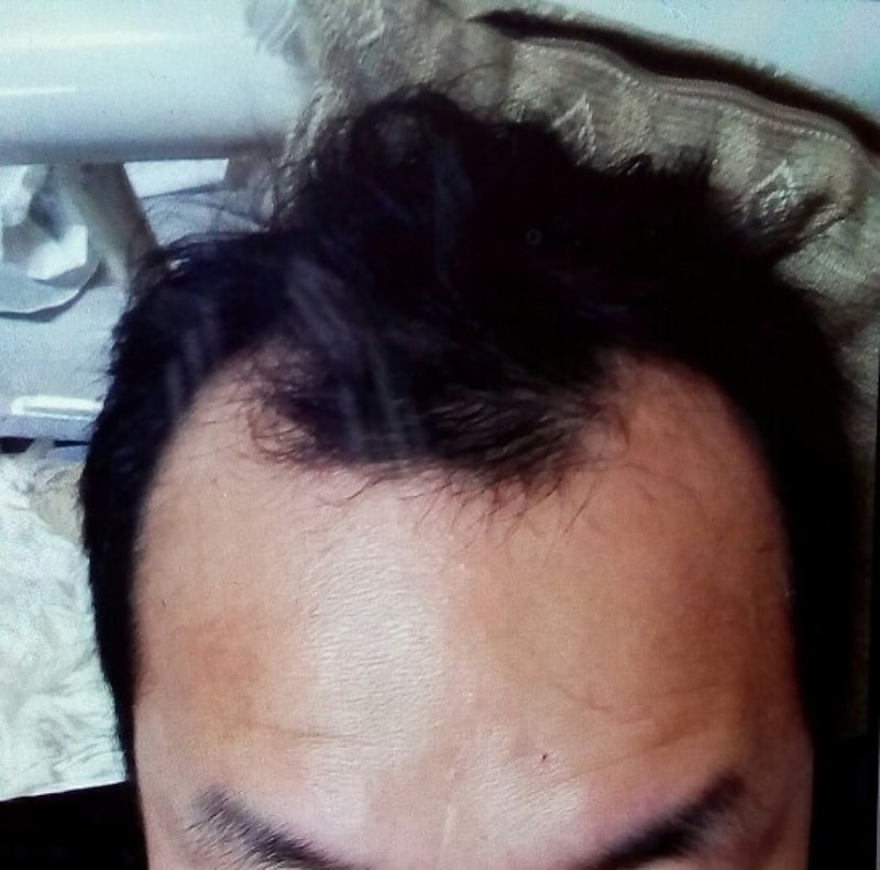 3600 implantable surgical method incision hospital Dana plastic surgery clinic It's been 10 days