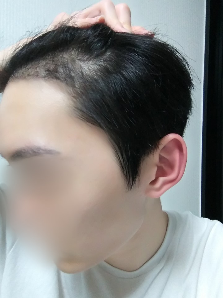 M-shaped non-cut 2000 Mo 5 months review