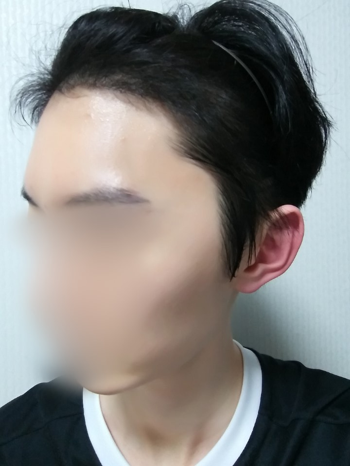 02.수술5달.jpg