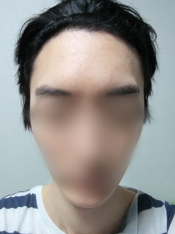 04.김재환_수술7달.jpg