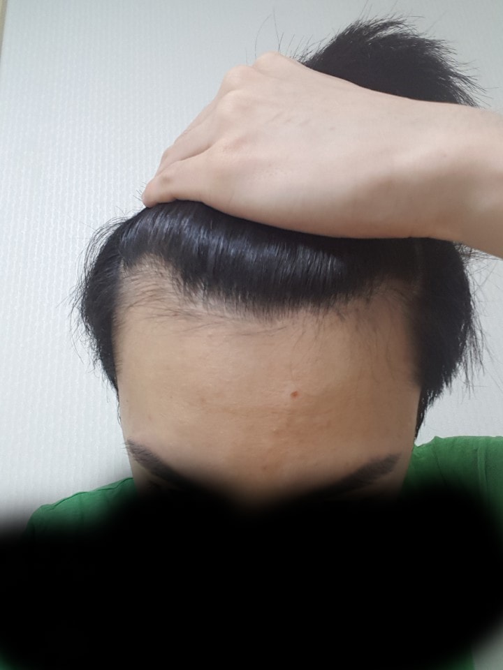Mo Plus M-shaped Vive incision 2000 Mo 7 months review