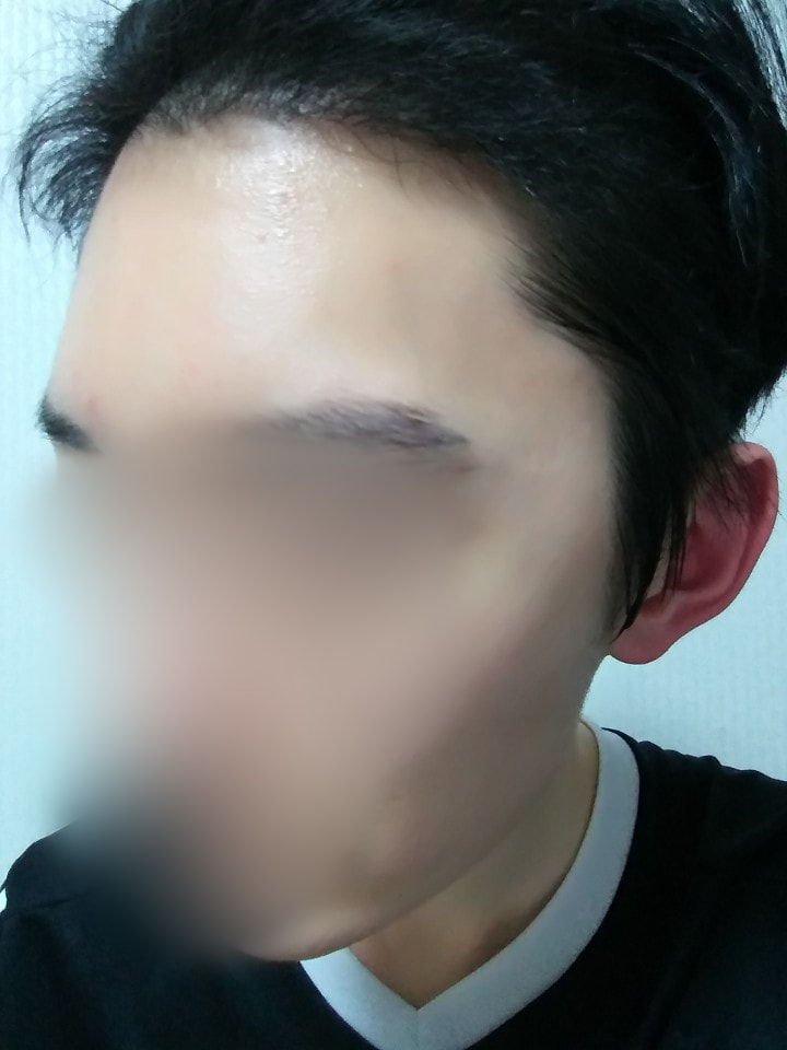 03.수술5달.jpg