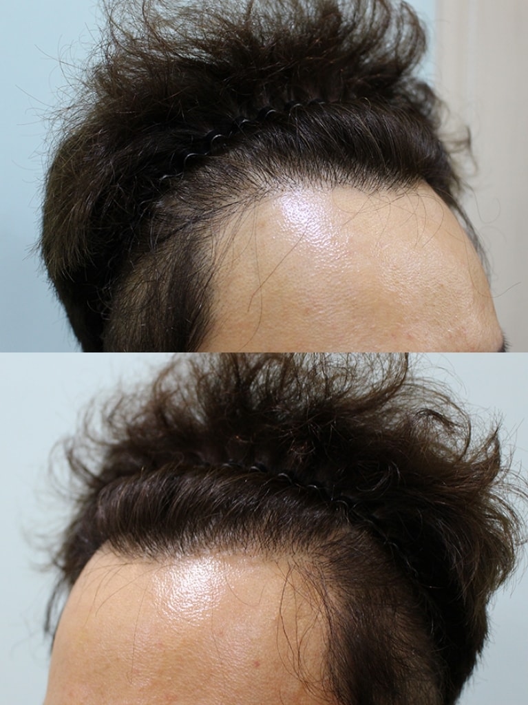 ヘアラインを整えて前の方に毛量を補強しました~
