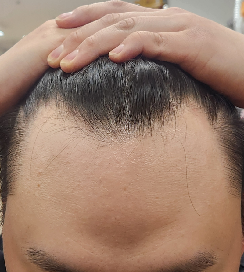 다나 1900모낭 유중호원장님 후기/ 빨리 할수록 확실히 유리합니다