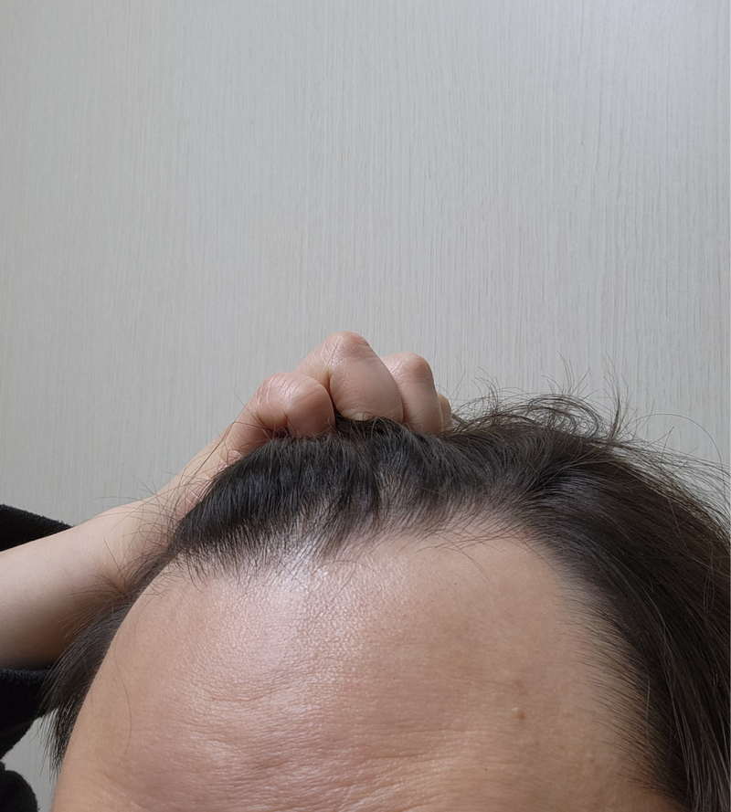 다나 1900모낭 모발이식 4개월차 가려움 해방