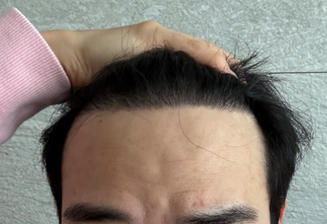 ダナ整形外科の非切開毛髪移植17ヶ月（笑）昔の写真と比べてみると変な気分ですね;;