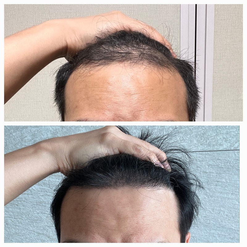 ダナで毛髪移植、いよいよ1年です