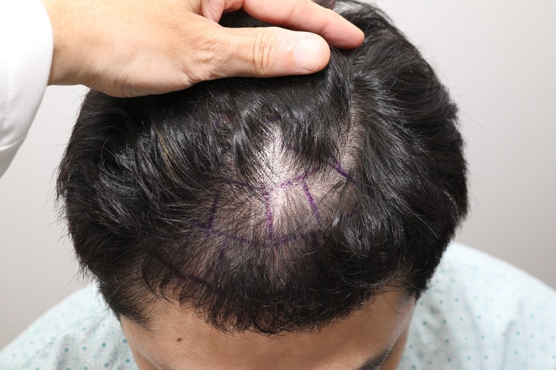 New Hair Seoul Branch Hair Transplantation in the 1st Year Late in the First Year (4,000 moles)