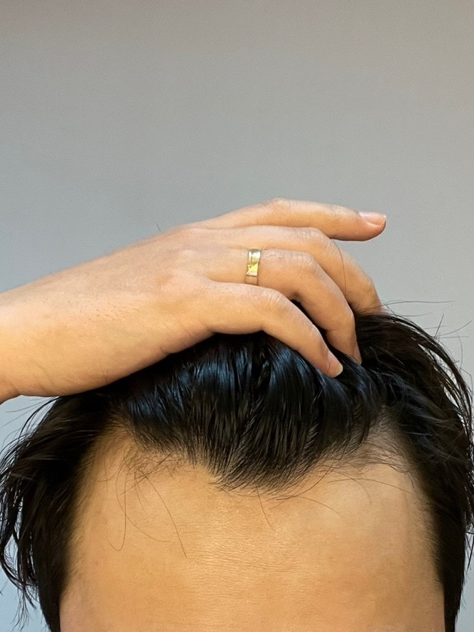 DANA MJ毛发移植后记