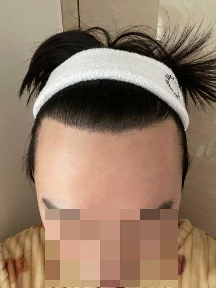 Dana Emja脱发的20代20个月后期