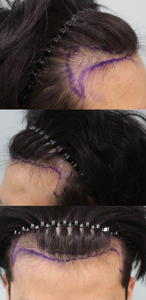 참닥터에서 수술한지 6개월째인데 어떤지 봐주세요