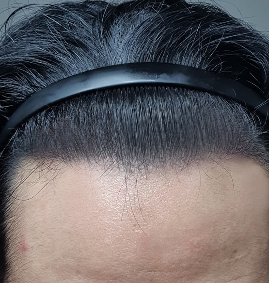 다나성형외과 무삭발비절개 14개월ㅎㅎ