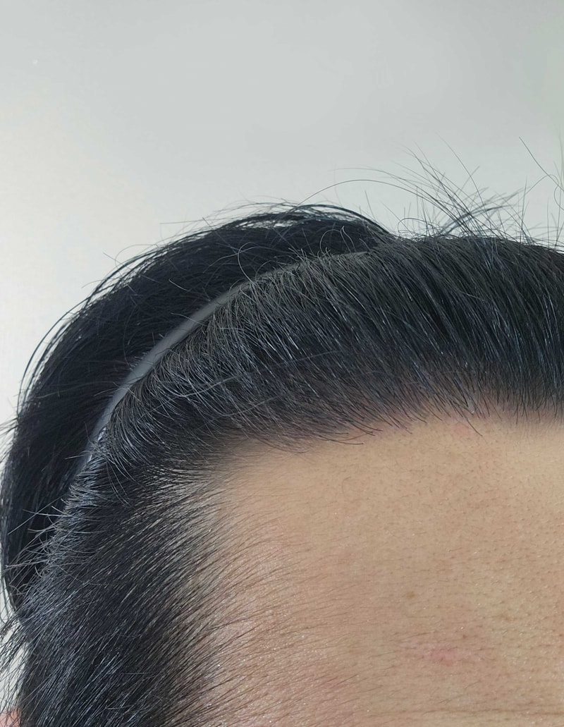 모발이식후18개월됐습니다.jpg
