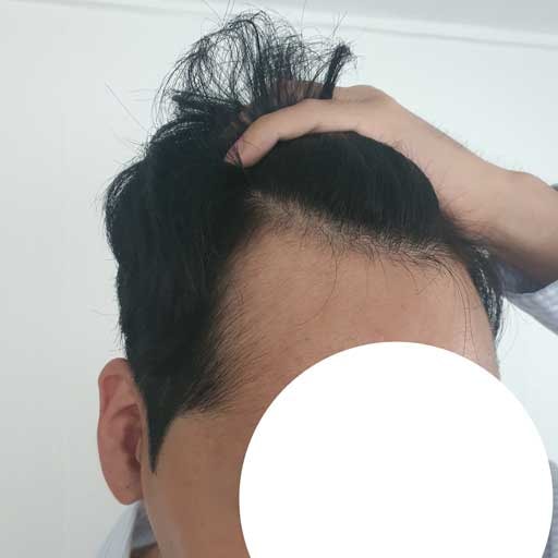 모발이식전과거.jpg