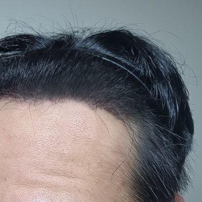 엠자탈모 다나성형외과 무삭발비절개 15개월