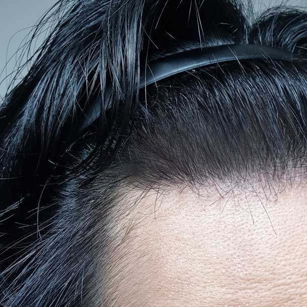 모발이식12개월째..jpg