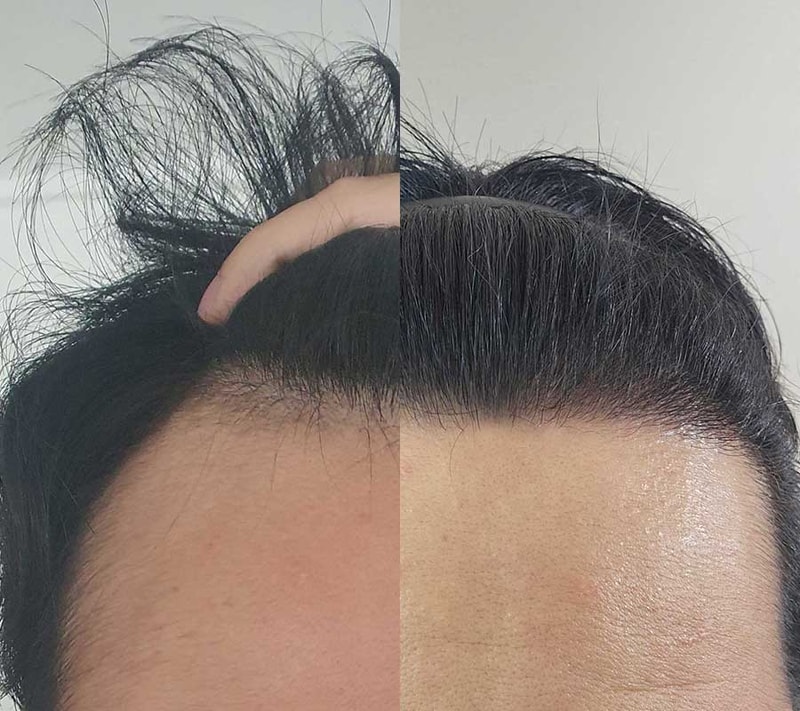 약한 엠자여도 모발이식을 추천하는 이유입니다ㅎㅎ 다나 무삭발비절개 18개월차 ㅎㅎ