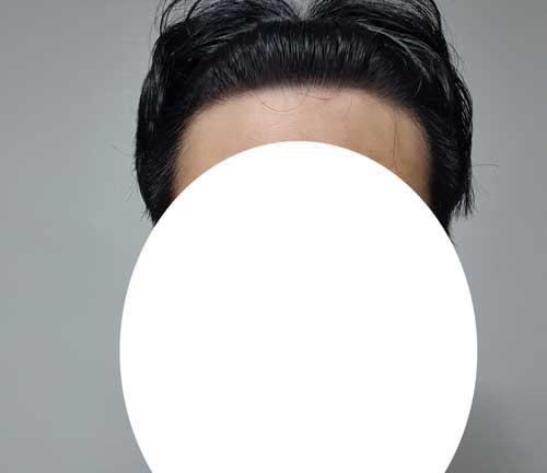 ダナ整形外科 無削髪毛髪移植 10ヶ月 デザイン助言