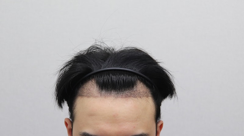 IMG_3954 3개월 경과.JPG
