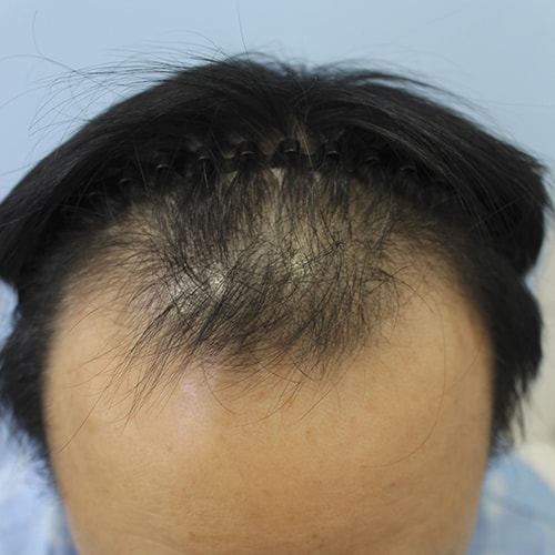 1次手術成功後、2次手術を受けました
