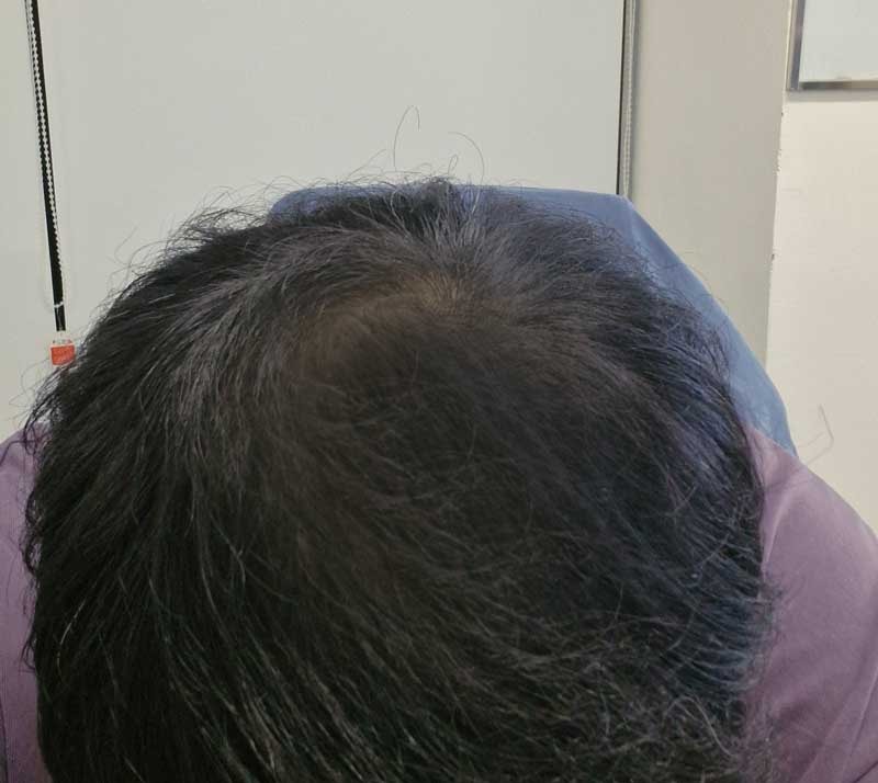 大量毛髪移植ダナ整形外科11ヶ月です