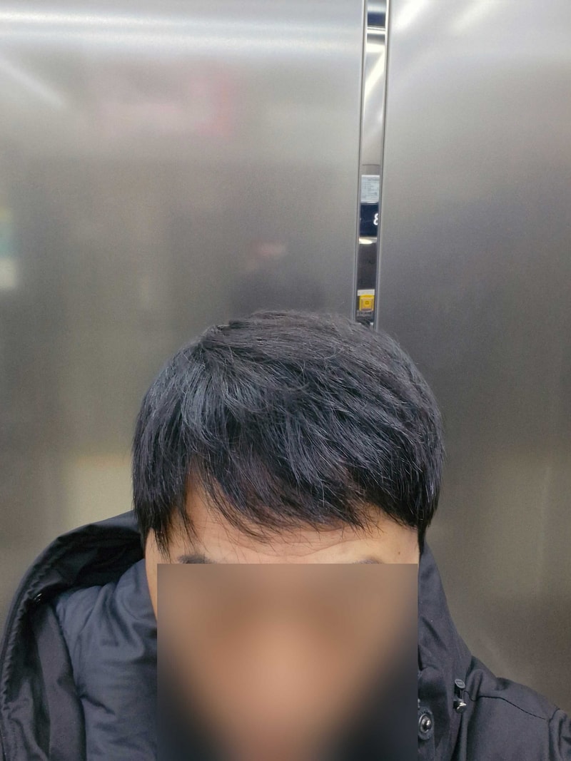 다나성형외과 비절개모발이식 17개월차